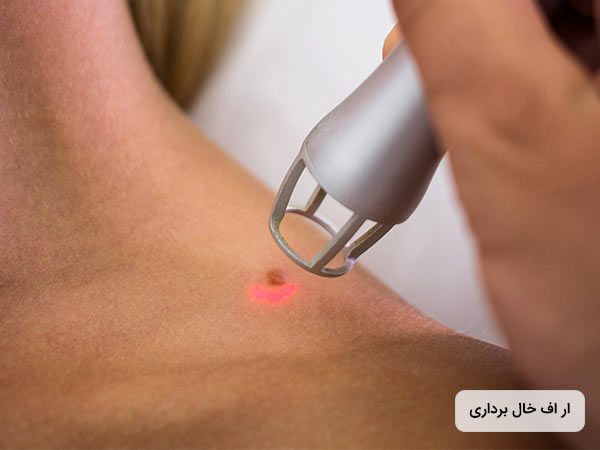 پزشک با استفاده از دستگاه ار اف در حال برداشتن خال روي پوست مي باشد.