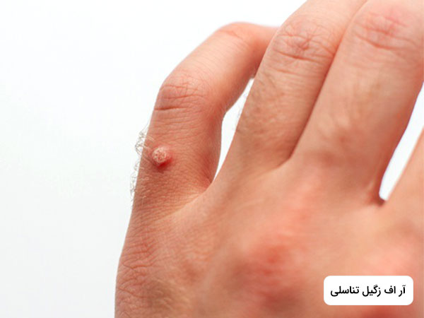 روي انگشت دست يک نفر ، زگيل وجود دارد.