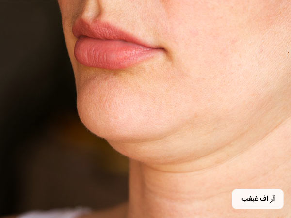 غبغب يک خانم در تصوير قابل مشاهده است. خانم پوست صورت نسبتا صافي دارد.