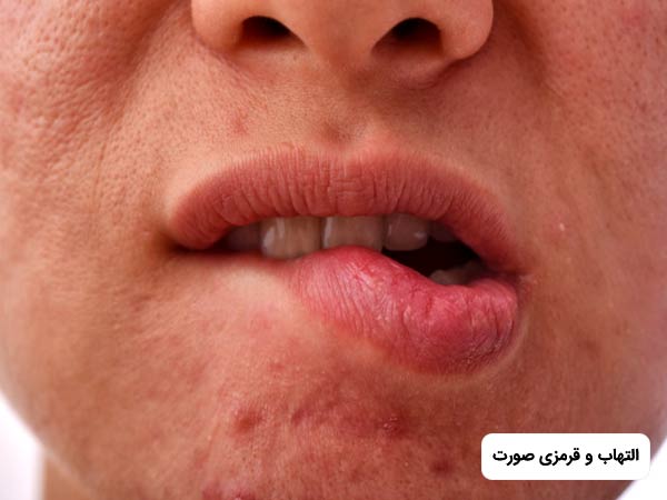 يک صورت داراي التهاب و قرمزي است و فرد در حال جويدن پوست لب خود با دندان است.