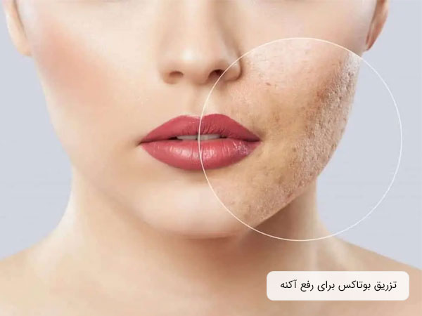 تصویر صورت یک خانم که ناحیه ای از آن دچار زخم و اسکار شده است. بیشتر صورت این خانم صاف و شفاف است . همچنین میزان زیادی از نواحی تصویر کدر و مات می باشد. بوتاکس صورت می تواند چاره کار باشد