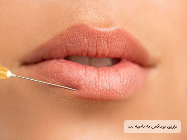 تصویری از لبان یک خانم در حال تزریق بوتاکس صورت با هدف جوانسازی . زمینه تصویر روشن و زرد رنگ است