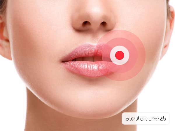 تصویر نیمه پایینی صورت یک خانم که لبهای موجود در آن دجار تبخال پس از تزریق ژل به ناحیه لب ها شده است. زمینه تصویر سفید می باشد