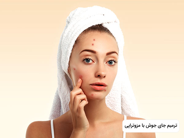خانمي در تصوير جوش هاي متعددي روي صورت خود دارد و در حال اشاره به جوش هاي خود با دست است.