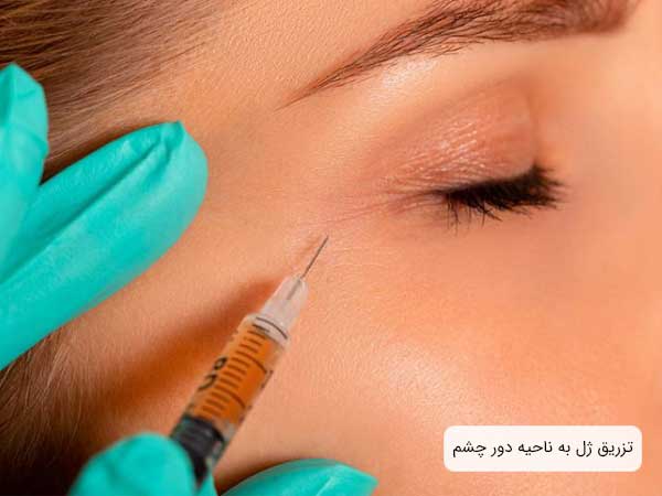 تصویری از خطوط زیر و دور چشم یک دختر خانم که توسط پزشک در حال تزریق ژل می باشد . زمینه تصویر سفید و دستکش دکتر آبی فیروزه ای . همچنین تصویر بسته از صورت است و سرنگ کاملا در تصویر مشهود می باشد