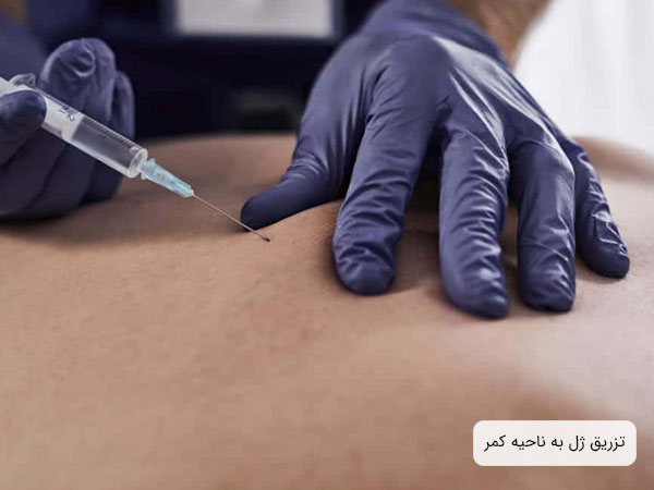 تصویر تزریق ژل به ناحیه کمر برای کاهش درد کمر . دستکش دکتر بنفش می باشد و زمینه تصویر کمر بیمار است