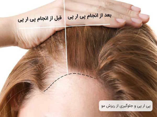 تصویر موهای یک خانم قبل و بعد از انجام پی ار پی مو . ریزش موهای این خانم بعد از استفاده از پی ار پی رفع شده است .