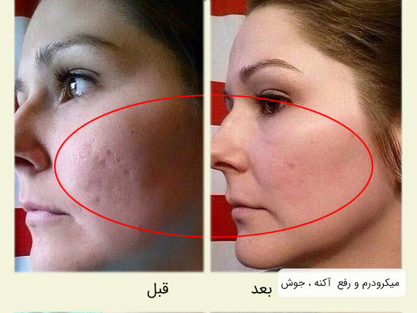تصویر قبل و بعد استفاده از میکرودرم برای رفع آکنه و جوش