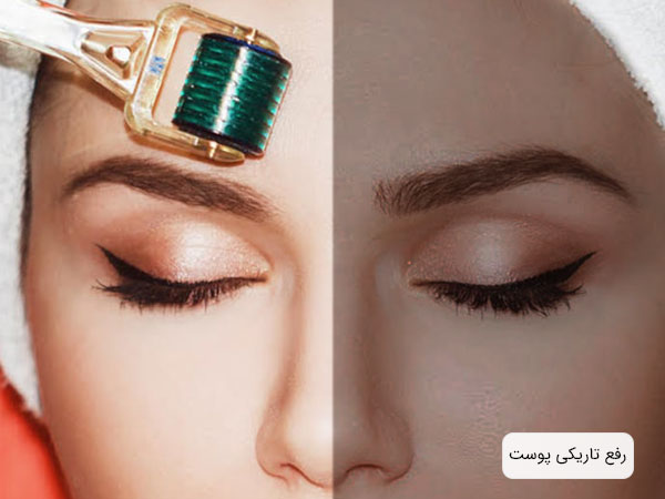 تصویر رفع عیب تاریکی پوست با استفاده از میکرونیدلینگ و دو نیمه تصویر در یک نما می باشند.