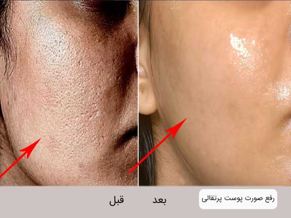 تصویر رفع عیب صورت پوست پرتقالی با استفاده از میکرونیدلینگ و دو تصویر در یک نما می بانشند.