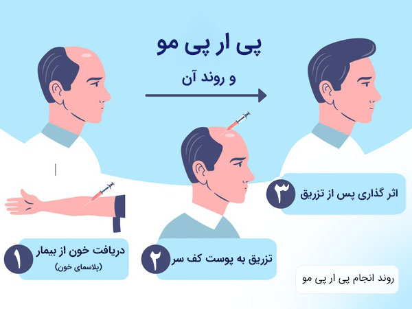 در تصویر مراحل تهیه و انجام پی ار پی مو به تصویر کشیده شده است . تصویر بیمار درسه حالت قبل از تزریق ، در هنگام تزریق و بعد از آن مشخص می باشد .