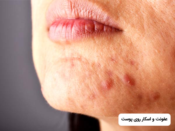 روي پوست صورت خانم عف.نت و اسکار وجود دارد که از عوارض جوانسازي با ليزر CO2 فرکشنال مي باشد.