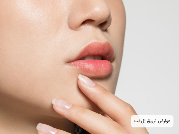 تصویر نیمه پایینی صورت یک خانم که لبهای موجود در آن دجار عوارض پس از تزریق ژل به ناحیه لب ها شده است. زمینه تصویر سفید می باشد