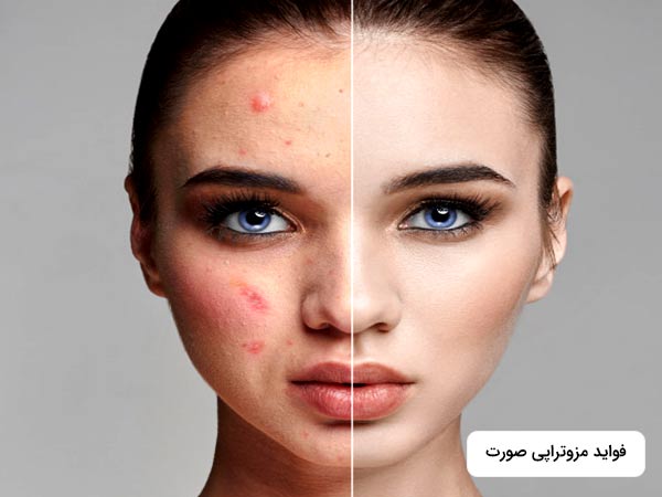 صورت خانم با استفاده از مزوتراپي و بدون استنفاده از مزوتراپي