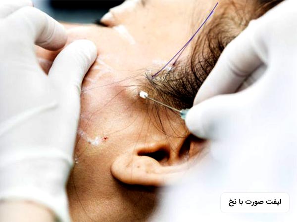 پزشک در حال کشيدن پوست صورت خانم به روش ليفت با نخ مي باشد. خانم روي تخت دراز کشيده است.
