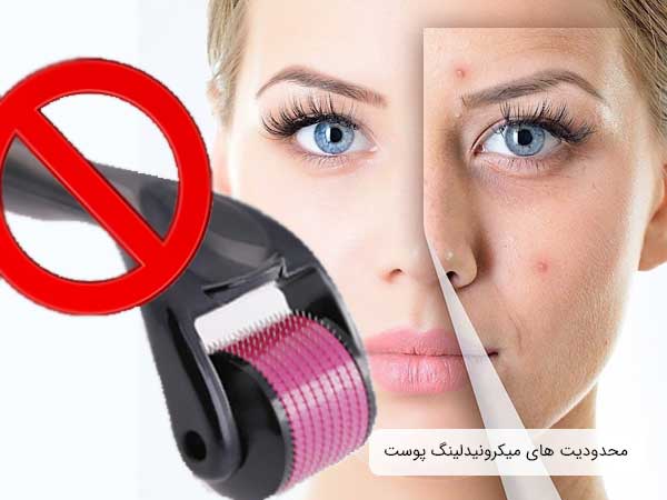تصویر صورت یک خانم به همراه یک عدد درما رولر و علامت ممنوعیت استفاده . زمینه تصویر سغید است و در روی صورت خانم تعدادی عفونت و تبخال وجود دارد که ممنوعیت یک روش را نشان می دهد
