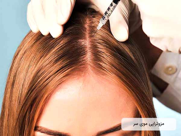 پزشک در حال ترمیم موی سر یک خانم به روش مزوتراپی می باشد. صورت خانم و پزشک در تصویر قابل مشاهده نیست. پزشک دستکش سفید به دست کرده است
