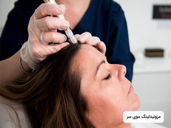 در تصوير خانمي روي تخت خوابيده است. پزشک در حال ترميم موي سر خانم با استفاده از روش مزونيدلينگ مي باشد. خانم چشمن خود را بسته است.