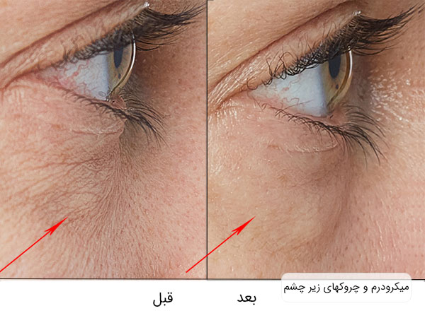 تصویر قبل و بعد استفاده از میکرودرم برای رفع خطوط و چین و چیروک عای زیر چشم