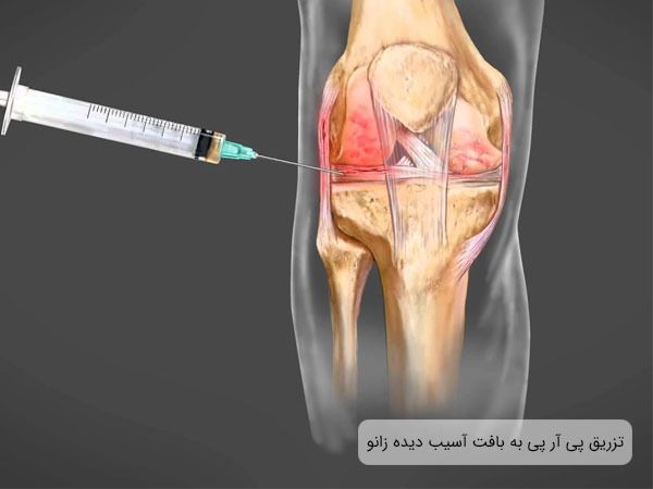 تصویر بافت آسیب دیده زانوی یک فرد که توسط تزریق پی آر پی درمان می شود. سرنگ در تصویر برای تزریق کاملا نمایان است. زمینه تصویر مشکی می باشد