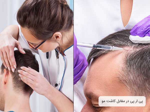 دو تصویر از دو نفر نشسته ، یک در حال تزریق پی ار پی مو و دیگری در حال کاشت مو می باشد . پزشک در یکی از تصاویر مشخص می باشد