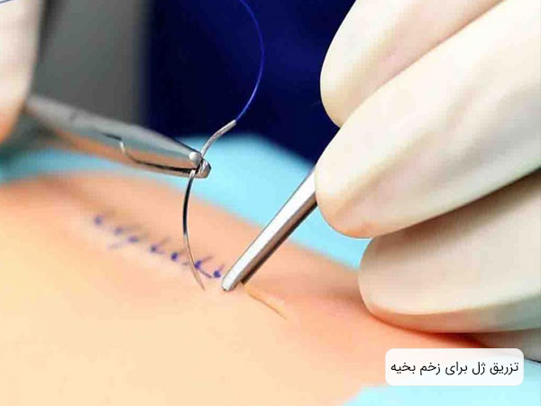 تصویری از بافت یک انسان که توسط پزشک بخیه زده می شود . بکگراند تصویر کدر و سدزن و نخ نمایان است