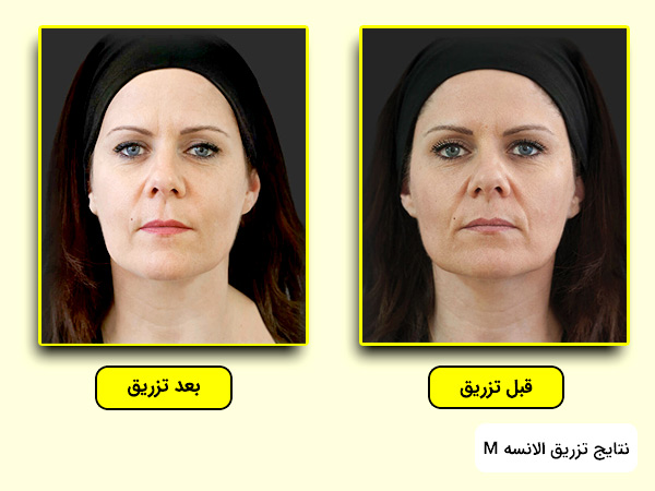 اثرات تزريق ژل الانسه ام برای رفع گودی زیر چشم