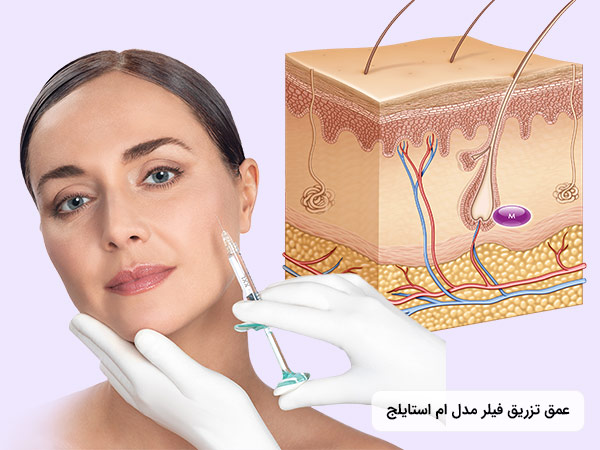 ميزان عمق تزريق فيلر بینی استايلج به پوست