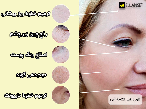 قیمت ژل خط خنده الانسه
