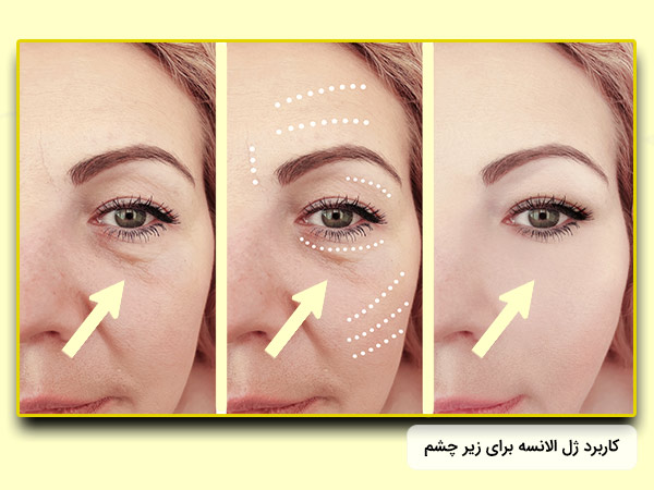 نتايج و قيمت ژل الانسه براي زير چشم مدل ام