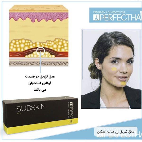 نمایش عمق تزریق فیلر ساب اسکین پرفکتا برای زاویه فک و صورت