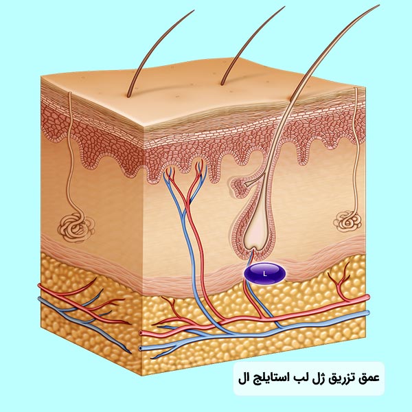 ميران عمق تزريق ژل لب استايلج L در پوست