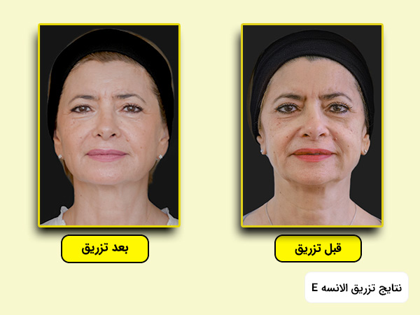 نتایج تزریق ژل الانسه مدل E