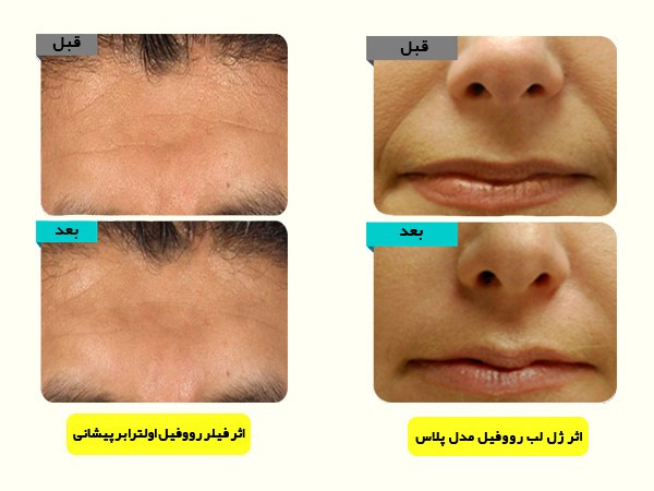 اثرات استفاده از ژل لب و فيلر بيني رووفيل