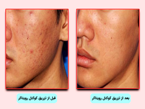 اثرات کوکتل استرچ کر رويتاکر بر روي صورت