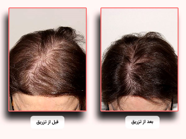 قيمت و اثرات شگفت انگيز کوکتل مو رويتاکر هيرکر براي زيبايي مو