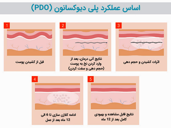 اساس عملکرد نخ های پلی دیوکسان PDO بر روي پوست در 5 مرحله
