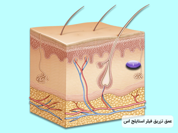 نمایش عمق تزريق قیمت ژل زير چشم استايلج S به پوست