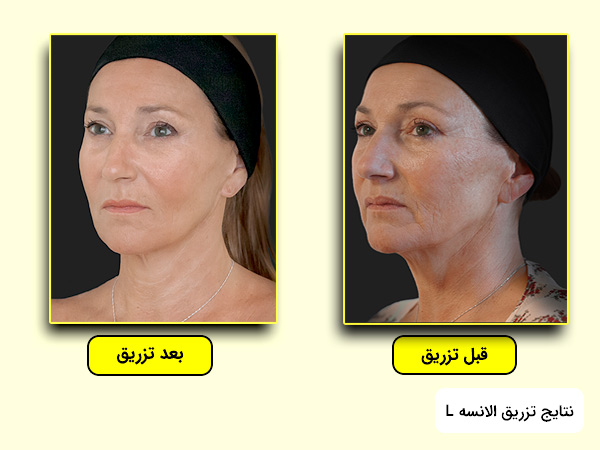 نتايج تزريق فيلر الانسه ال برای رفع جای جوش