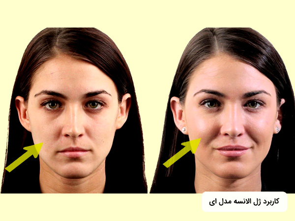 کاربرد و قيمت فيلر الانسه براي گونه
