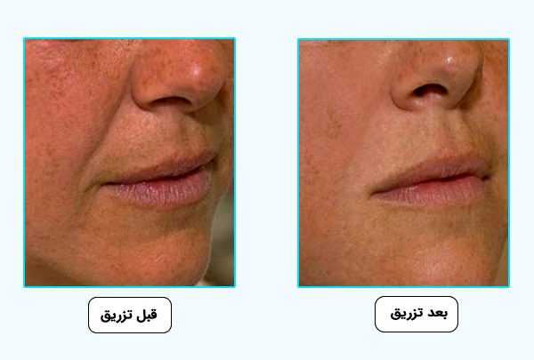 اثر شگفت انگیز فیلر مدل ام استایلج روی پوست اطراف بینی