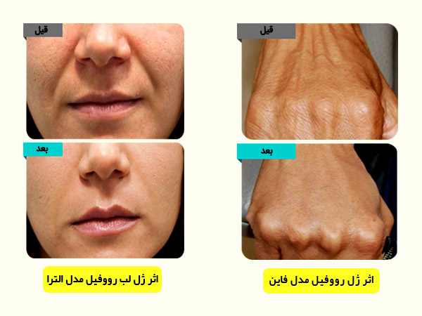 اثرات استفاده از ژل لب و فيلر بينی رووفيل