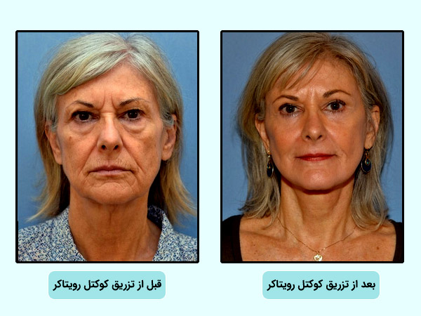 قبل و بعد از استفاده از کوکتل مزوتراپي رويتاکر