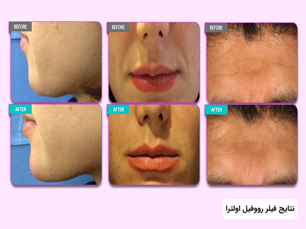 نتايج ژل اولترا رووفيلکره بر روی لب و پيشاني و اطراف لب