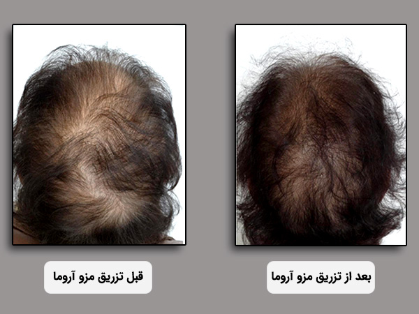 قيمت کوکتل مزوتراپي مزو آروما مخصوص تقويت مو
