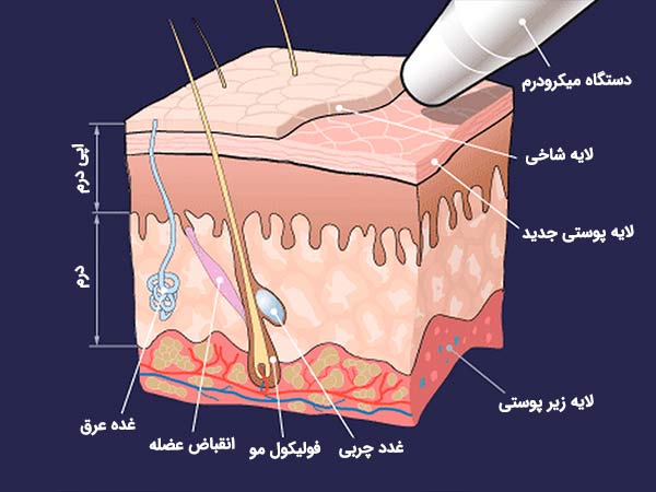اثرگذاري دستگاه ميکرودرم بر روي پوست. تفاوت میکرودرم با هیدرودرم