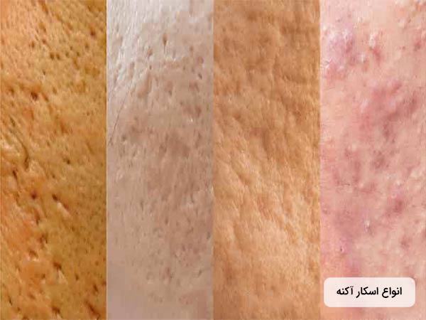 انواع اسکار هاي آکنه