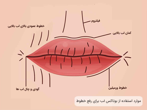 نواح از لب که مشمول مصورف بوتاکس برای از بین رفتن انواع چین و چروک و خطوط نیمه سطحی و کم عمق می شوند در تصویر مشخص می باشد