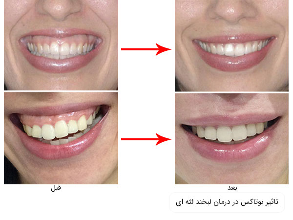 تاثیر سم بوتاکس در رفع و اصلاح نقص گامی اسمیل در تصویر مشخص می باشد .