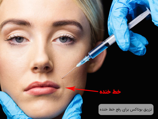 تصویر صورت یک خانم در حال تزریق بوتاکس برای از بین رفتن خط خنده با زمینه مشکی و تیره . سرتگ در تصویر مشخص می باشد